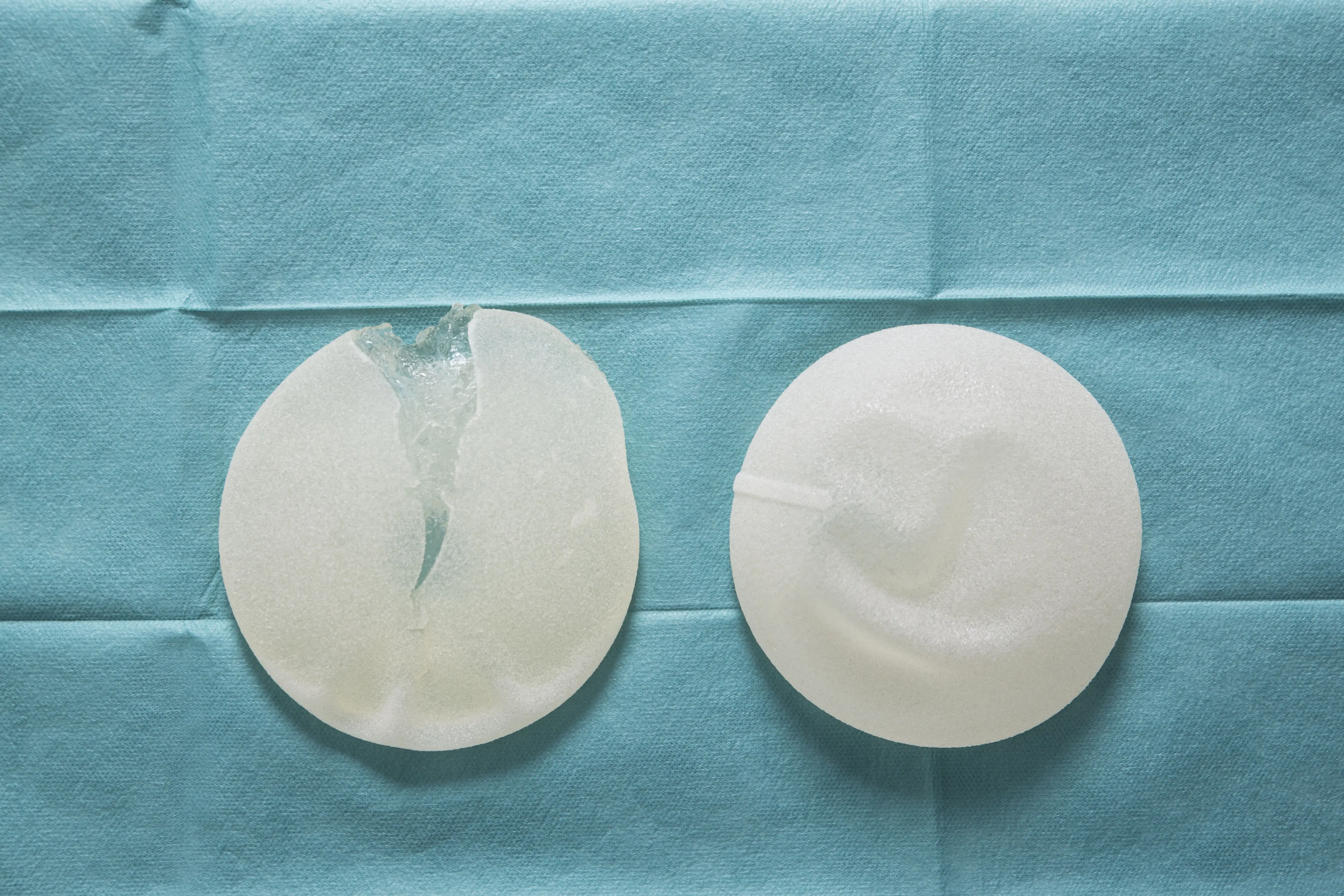 Symbolbild: Brustimplantate aus Silikon auf einem OP Tuch. Eines der beiden Vorführmodelle hat einen Riß.