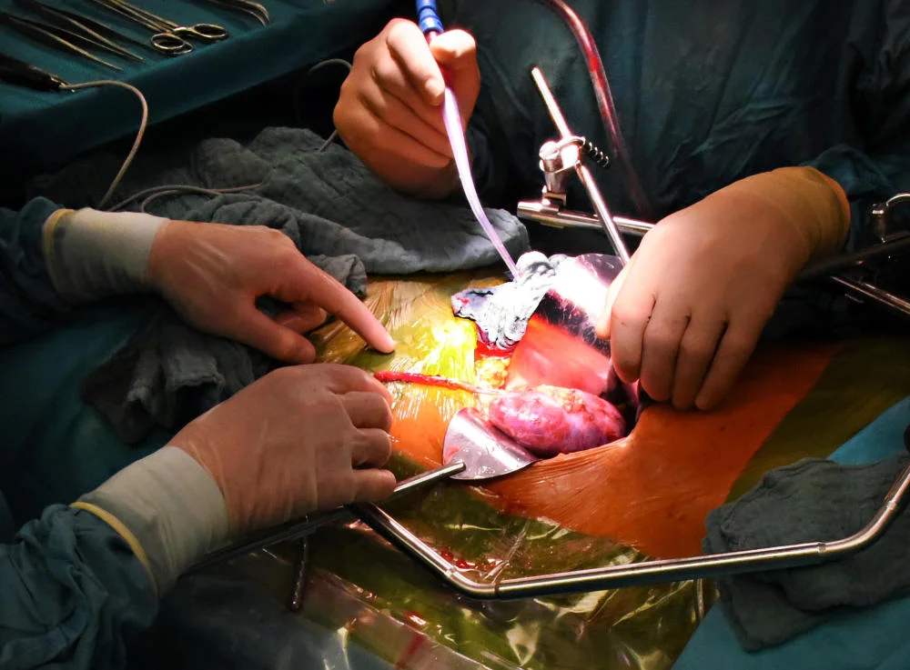 Transplantation einer Niere